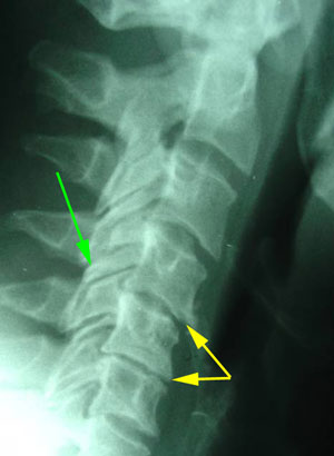 disc degeneration treated at OrthoIllinois Chiropractic
