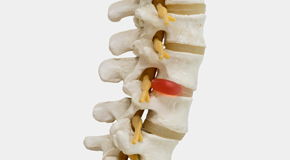 McHenry chiropractic conservative care helps even giant disc herniations go away
