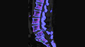 OrthoIllinois Chiropractic is aware that inflammatory spinal gout is a differential diagnosis to consider for patients who present with back pain and other spine related symptoms.