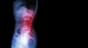 McHenry Chiropractic Care of Spondylolisthesis 