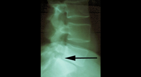 McHenry spondylolisthesis 