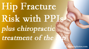 OrthoIllinois Chiropractic shares new research describing increased risk of hip fracture with proton pump inhibitor use. 