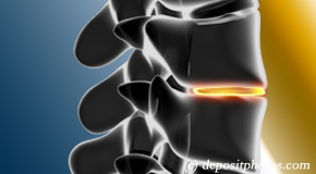 McHenry degenerative spinal changes 