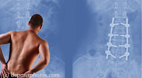 McHenry chiropractic relief for back pain after back surgery