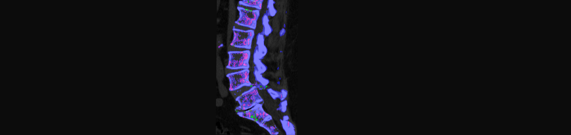 OrthoIllinois Chiropractic is aware that inflammatory spinal gout is a differential diagnosis to consider for patients who present with back pain and other spine related symptoms.