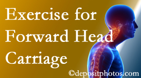 McHenry chiropractic treatment of forward head carriage is two-fold: manipulation and exercise.