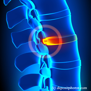 picture of lumbar McHenry disc herniation