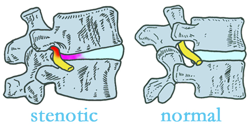 McHenry stenotic and normal spinal discs